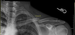 Left Clavicle fracture Xrays from Oct 27th, 2012.