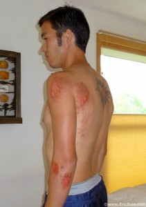 Road rash and cuts received during the fall in Bear Canyon, the worst of the accident isn't visible though.