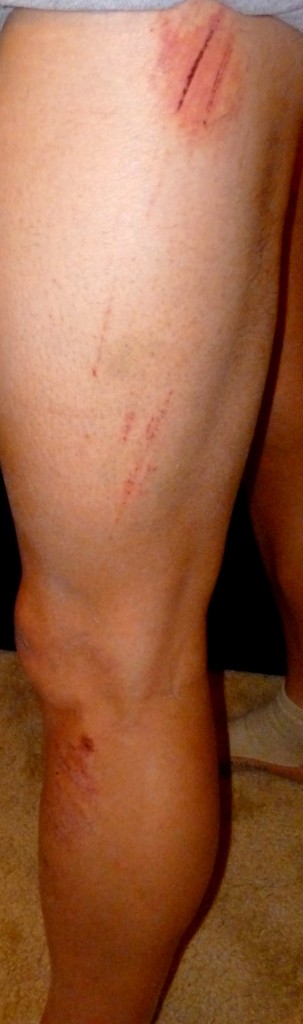 The road rash/scratches on my legs as well. They run from the calf to the upper thigh.
