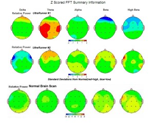 QEEG brain scans from two different Ultrarunners (top/middle) and one normal (bottom). The more orange and red indicate increases above normal.